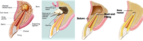 Apical Resection