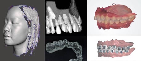 Digitale orthodontische behandeling