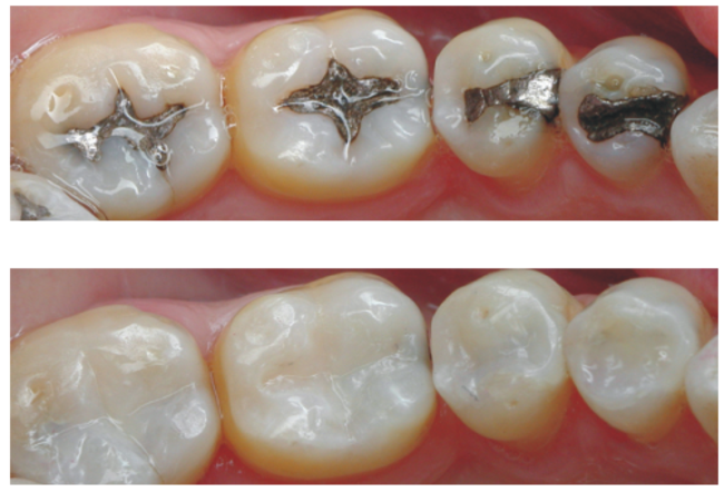 Amalgam Fillings