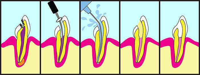 Root Treatment